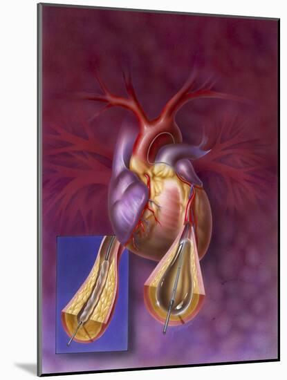 Insertion of Balloon into Atherosclerotic Artery-null-Mounted Art Print