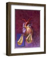 Insertion of Balloon into Atherosclerotic Artery-null-Framed Art Print