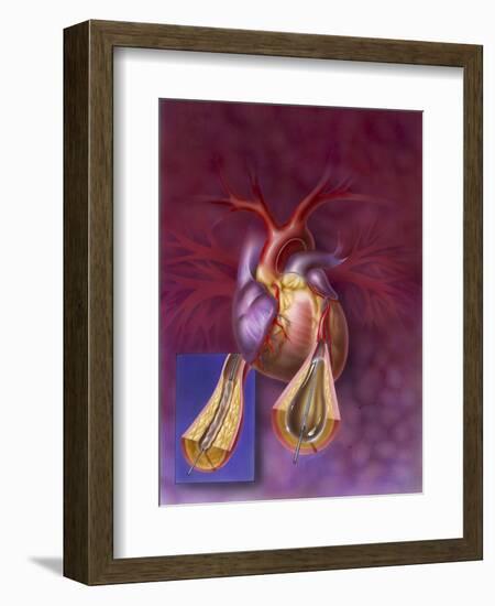 Insertion of Balloon into Atherosclerotic Artery-null-Framed Art Print