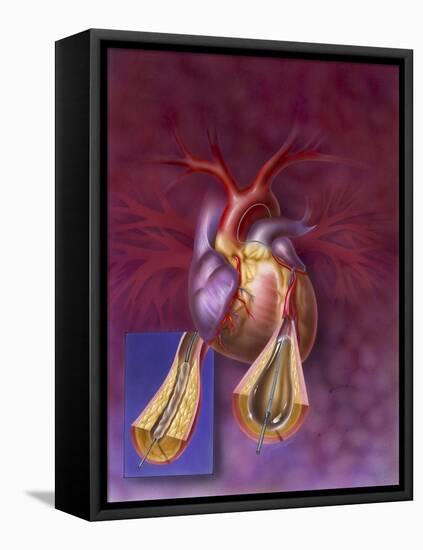 Insertion of Balloon into Atherosclerotic Artery-null-Framed Stretched Canvas