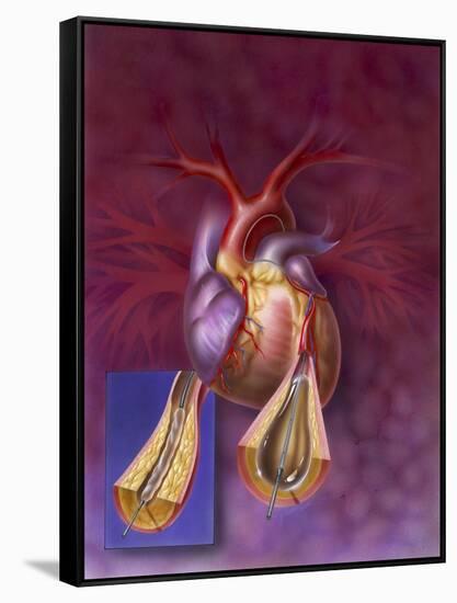 Insertion of Balloon into Atherosclerotic Artery-null-Framed Stretched Canvas