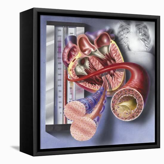Interior View of Heart with Detail of Muscle Cells and Atherosclerotic Artery-null-Framed Stretched Canvas
