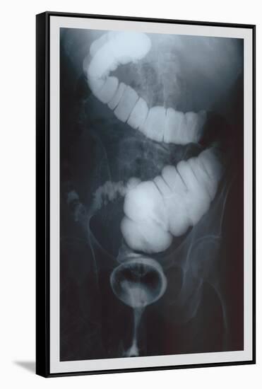 Intestine Barium-null-Framed Stretched Canvas