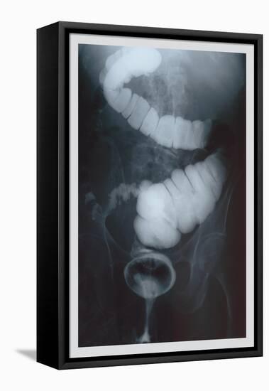 Intestine Barium-null-Framed Stretched Canvas