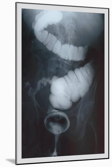 Intestine Barium-null-Mounted Art Print