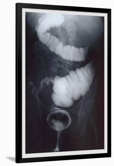 Intestine Barium-null-Framed Art Print