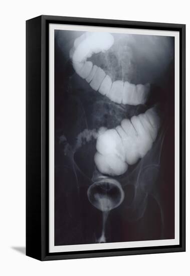 Intestine Barium-null-Framed Stretched Canvas
