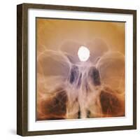 Intracranial Berry Aneurysm, X-ray-ZEPHYR-Framed Premium Photographic Print