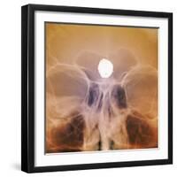 Intracranial Berry Aneurysm, X-ray-ZEPHYR-Framed Premium Photographic Print