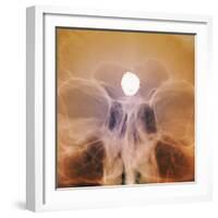 Intracranial Berry Aneurysm, X-ray-ZEPHYR-Framed Premium Photographic Print