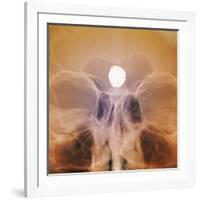 Intracranial Berry Aneurysm, X-ray-ZEPHYR-Framed Photographic Print