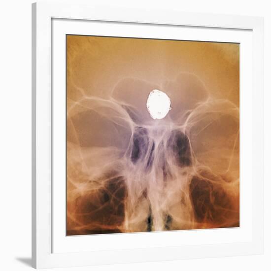 Intracranial Berry Aneurysm, X-ray-ZEPHYR-Framed Photographic Print