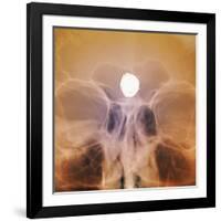 Intracranial Berry Aneurysm, X-ray-ZEPHYR-Framed Photographic Print