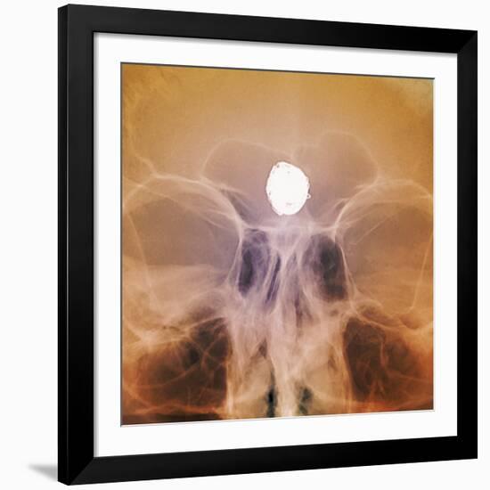 Intracranial Berry Aneurysm, X-ray-ZEPHYR-Framed Photographic Print