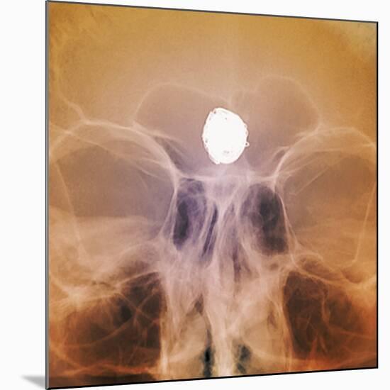 Intracranial Berry Aneurysm, X-ray-ZEPHYR-Mounted Photographic Print