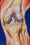 Osteoarthritic Knee-John Bavosi-Photographic Print