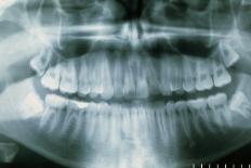 Panoramic Dental X-ray of Impacted Wisdom Teeth-Kaj Svensson-Photographic Print