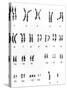 Karyotype of Chromosomes In Down's Syndrome-L. Willatt-Stretched Canvas