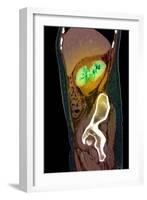 Kidney Damage, CT Scan-Du Cane Medical-Framed Photographic Print