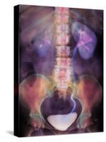 Kidney Stone In Ureter-Science Photo Library-Stretched Canvas