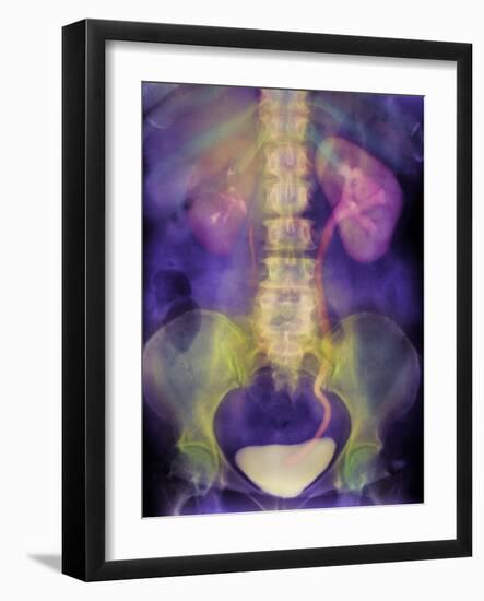 Kidney Stone In Ureter-Science Photo Library-Framed Photographic Print