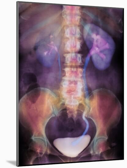 Kidney Stone In Ureter-Science Photo Library-Mounted Photographic Print