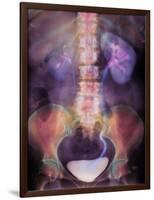 Kidney Stone In Ureter-Science Photo Library-Framed Photographic Print