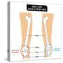 Knee Joint - Bones (Femur, Tibia, Fibula, Patella)-udaix-Stretched Canvas