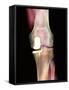 Knee Joint Prosthesis, X-ray-Science Photo Library-Framed Stretched Canvas