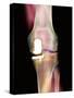 Knee Joint Prosthesis, X-ray-Science Photo Library-Stretched Canvas