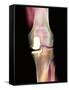 Knee Joint Prosthesis, X-ray-Science Photo Library-Framed Stretched Canvas