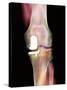 Knee Joint Prosthesis, X-ray-Science Photo Library-Stretched Canvas