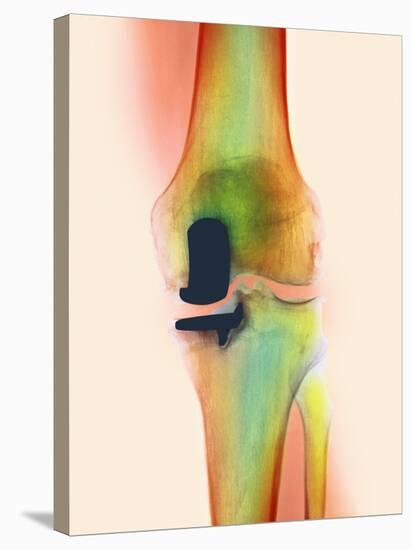 Knee Joint Prosthesis, X-ray-Science Photo Library-Stretched Canvas