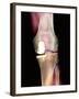 Knee Joint Prosthesis, X-ray-Science Photo Library-Framed Photographic Print