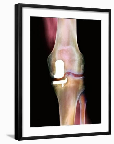 Knee Joint Prosthesis, X-ray-Science Photo Library-Framed Photographic Print