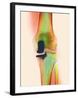 Knee Joint Prosthesis, X-ray-Science Photo Library-Framed Photographic Print