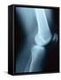 Knee Joint X-Ray-Robert Llewellyn-Framed Stretched Canvas