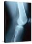 Knee Joint X-Ray-Robert Llewellyn-Stretched Canvas