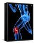 Knee Pain, Conceptual Artwork-SCIEPRO-Framed Stretched Canvas