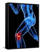 Knee Pain, Conceptual Artwork-SCIEPRO-Framed Stretched Canvas