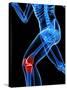 Knee Pain, Conceptual Artwork-SCIEPRO-Stretched Canvas