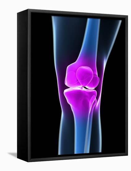 Knee Pain, Conceptual Artwork-SCIEPRO-Framed Stretched Canvas