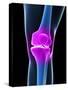 Knee Pain, Conceptual Artwork-SCIEPRO-Stretched Canvas