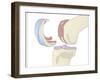 Knee Replacement, Artwork-Peter Gardiner-Framed Photographic Print