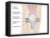 Knee Replacement, Artwork-Peter Gardiner-Framed Stretched Canvas