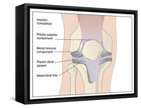 Knee Replacement, Artwork-Peter Gardiner-Framed Stretched Canvas