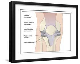 Knee Replacement, Artwork-Peter Gardiner-Framed Photographic Print