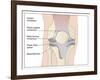 Knee Replacement, Artwork-Peter Gardiner-Framed Photographic Print