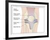 Knee Replacement, Artwork-Peter Gardiner-Framed Photographic Print