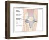 Knee Replacement, Artwork-Peter Gardiner-Framed Photographic Print